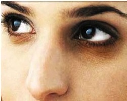 طبیعیترین درمان برای سیاهی دور چشم